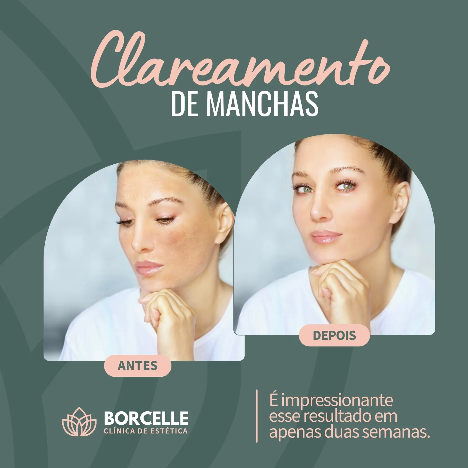 Template de post para Instagram com duas fotos de uma mulher, uma mostrando manchas na pele (Antes) e outra com a pele clara e uniforme (Depois). O título é "Clareamento de Manchas". Ao lado, o logo "Borcelle Clínica de Estética" e um texto sobre resultados em duas semanas.