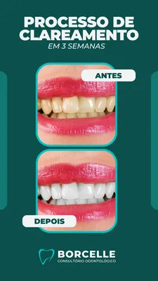 Template de Story para Instagram com fundo azul escuro e verde água, mostrando duas fotos de um sorriso com a legenda "Antes" e "Depois". A foto "Antes" exibe dentes amarelados, enquanto a "Depois" revela um sorriso branco e brilhante, com o logo "Borcelle Consultório Odontológico" na parte inferior.